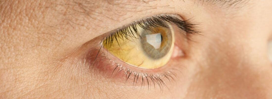Gilbert Syndrome