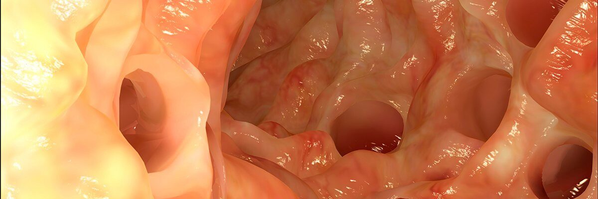 Diverticulitis