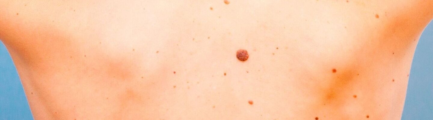 Skin Cancer