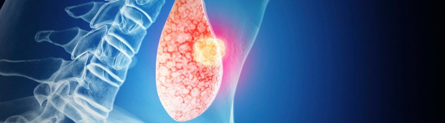 Thyroid Cancer
