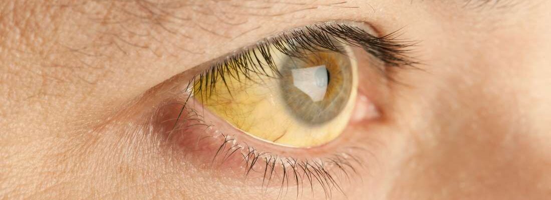Jaundice
