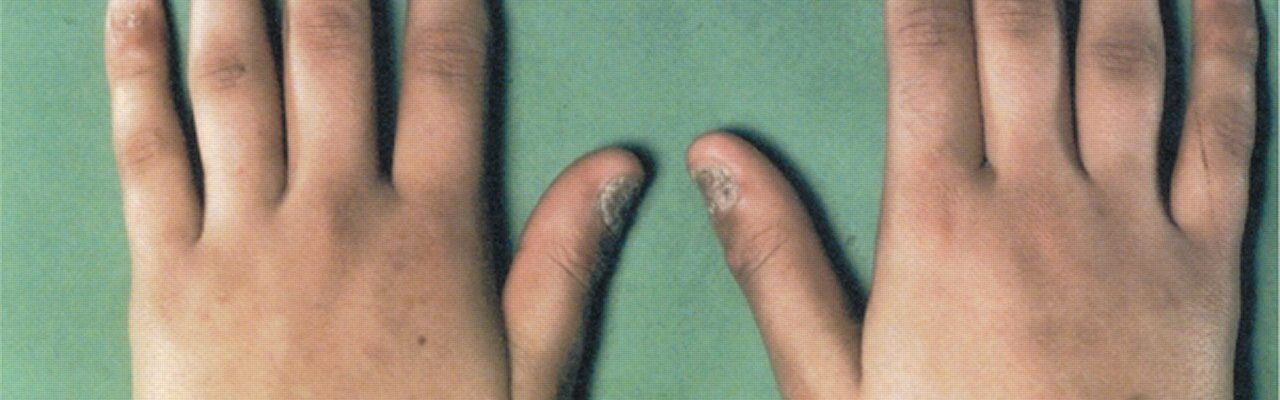 Addison’s Disease