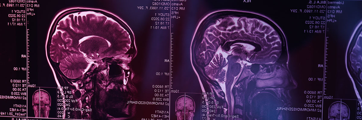 Brain Cancer