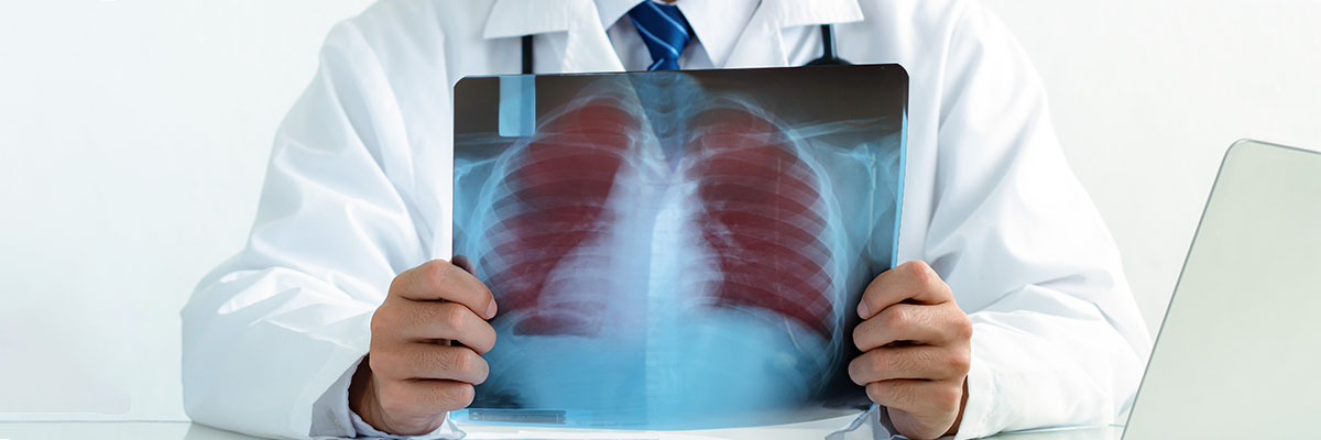 Bronchiectasis