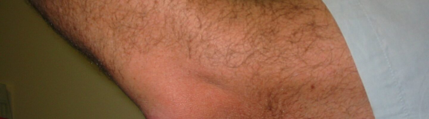 Bursitis