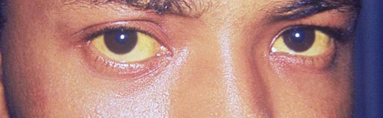 Yellowing of the Eyes: Is It Hepatitis B?