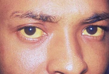jaundice eye