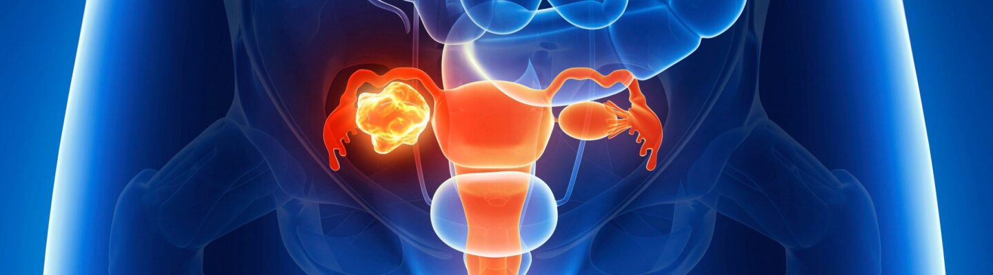 Ovarian Cancer