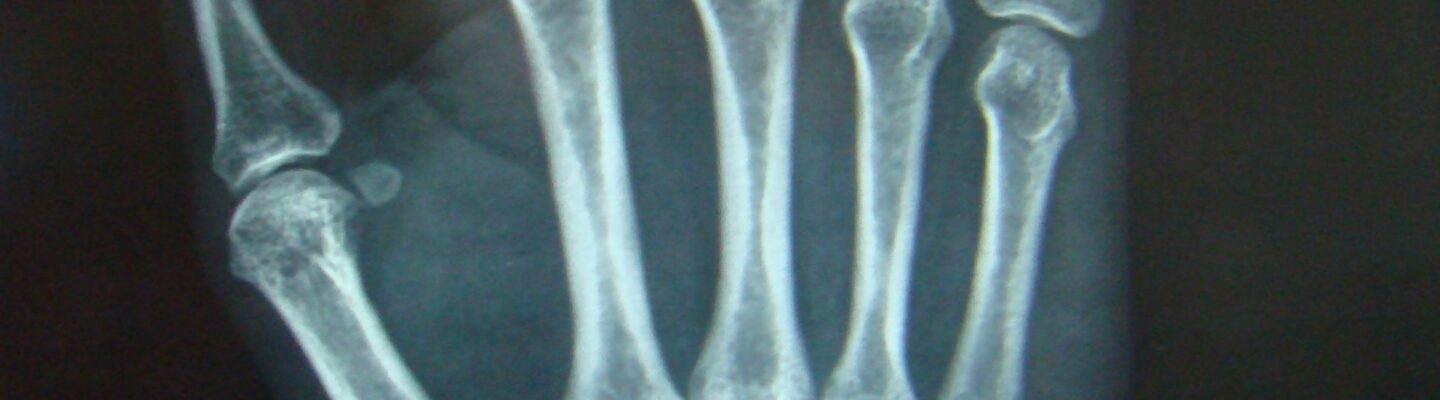 Bone Cancer