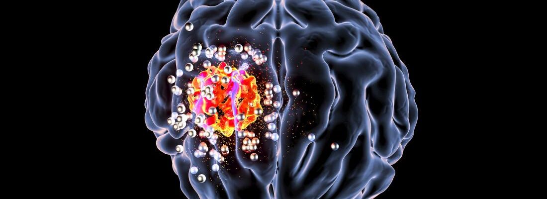 Brain Cancer