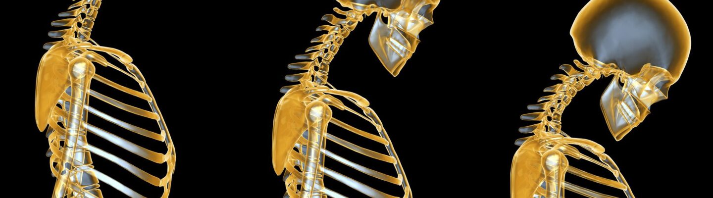 How to Prevent Osteoporosis