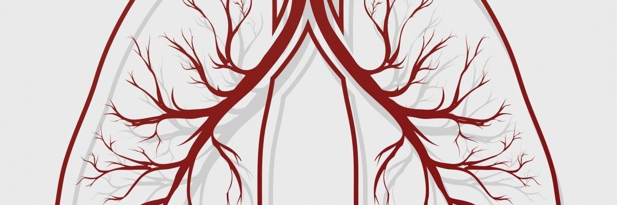 Bronchiectasis