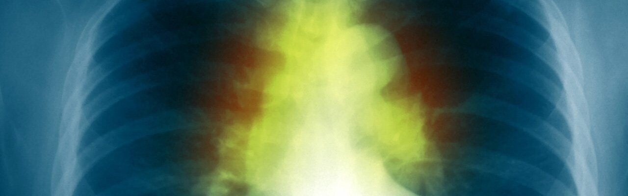 Sarcoidosis