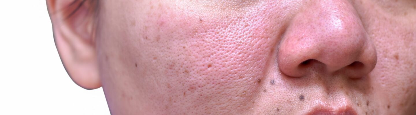Lupus
