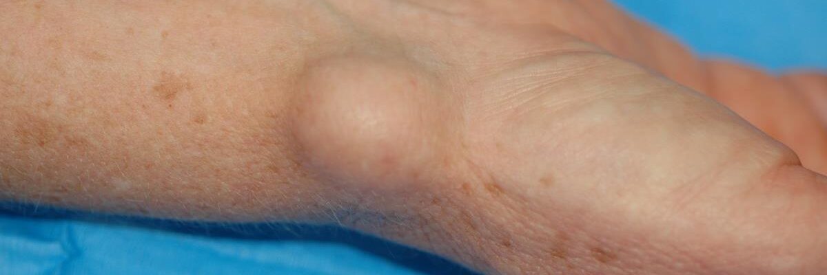 What Are the Treatments for Ganglion Cysts