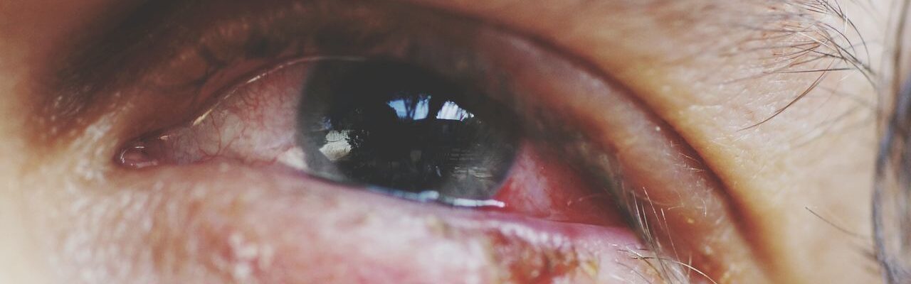 Red Eyes: Could It Be Sore Eyes?