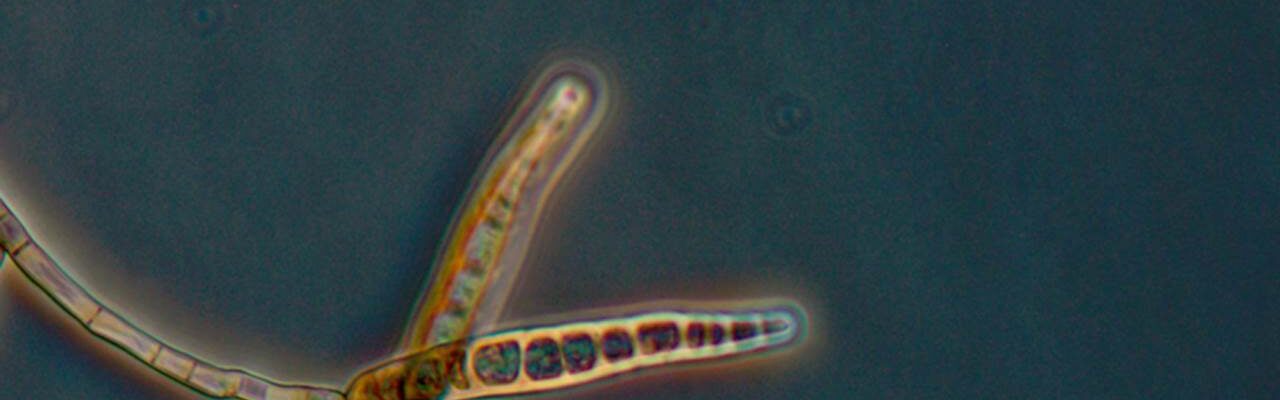 Fungal Meningitis Outbreak in the United States: 137 Infected, 12 Dead