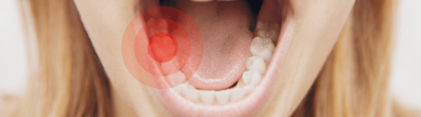 What Are the Symptoms of Tooth Decay