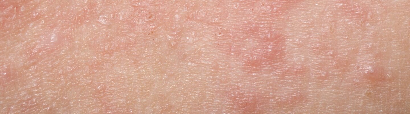 Swollen Lymph Nodes All Over the Body: What Could It Be?