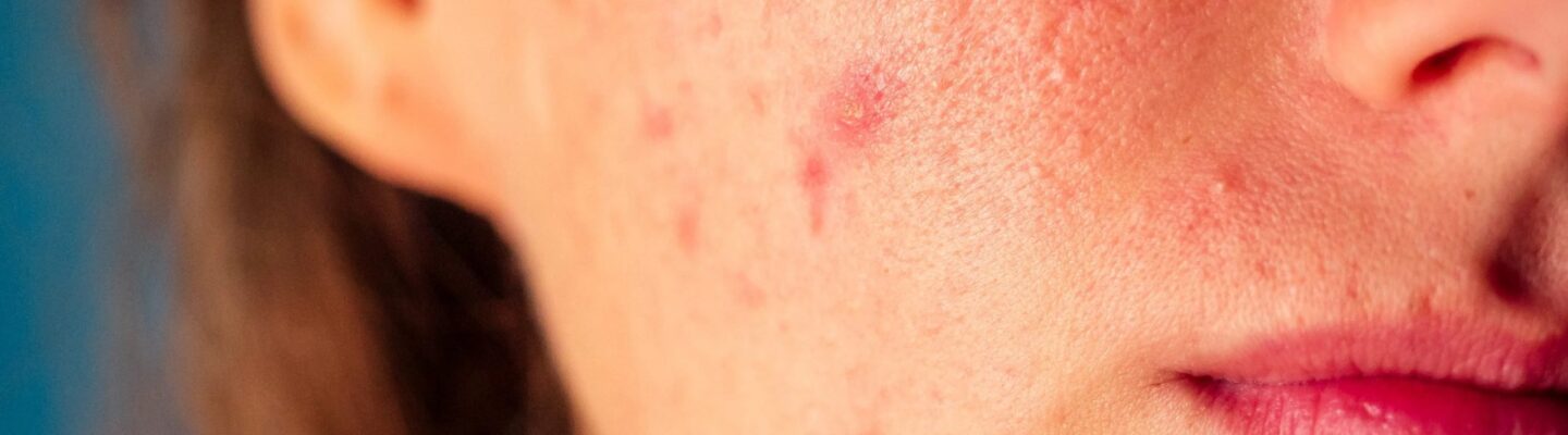 Althea o Diane pills: Pampa-tanggal ng pimples?