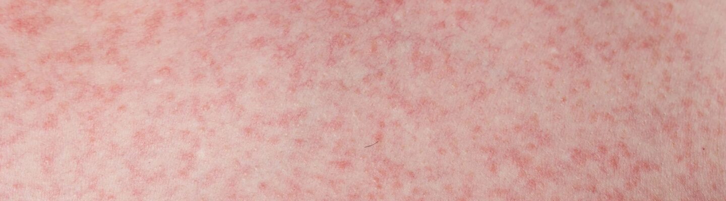 Are Dengue Fever Rashes Itchy?
