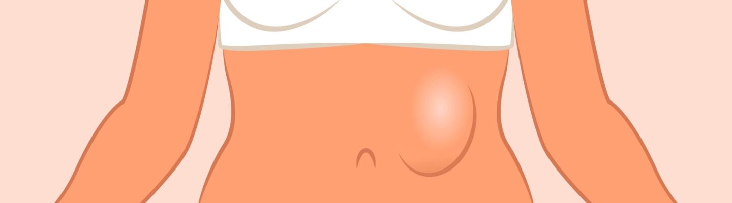 Hernia
