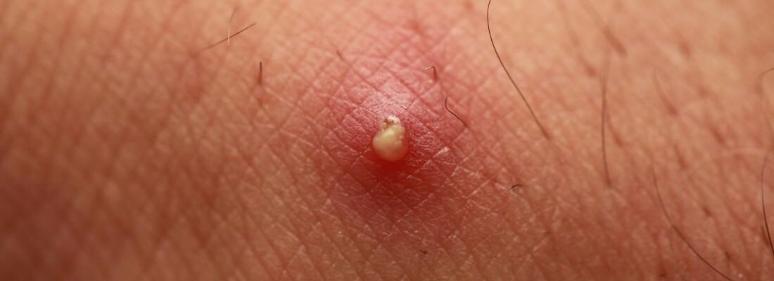 How to Prevent Boils