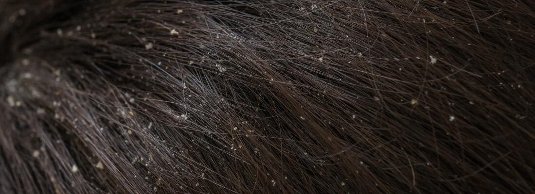 Dandruff in Children: Causes, Remedies, and When to See a Doctor