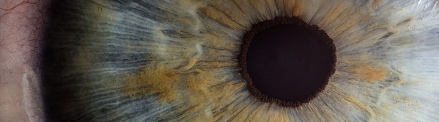 Eye Cancer