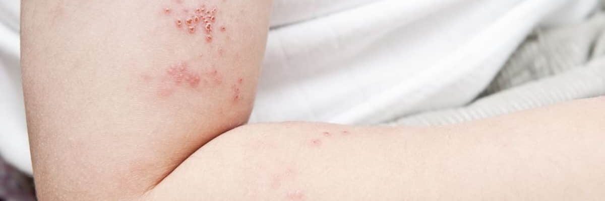 ‘Reactivation of Chickenpox’: Herpes zoster o shingles