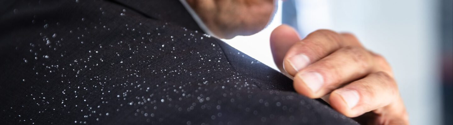 How is Dandruff Prevented