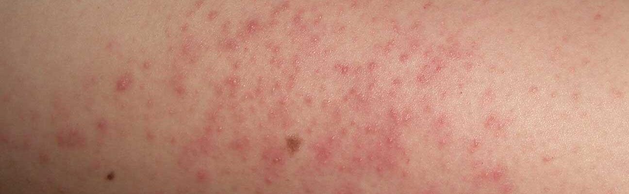 Keratosis Pilaris (KP): Small Bumps on the Arms, Common Among Teens