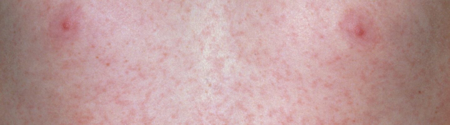 How German Measles (Rubella) is Diagnosed