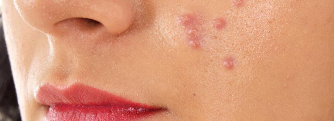Pimples (Acne)