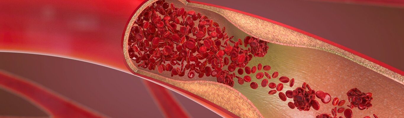 Anemia