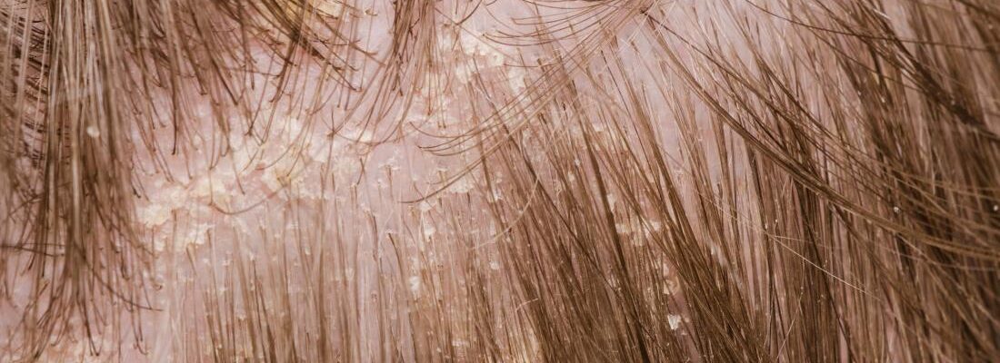 What is the Treatment for Dandruff?