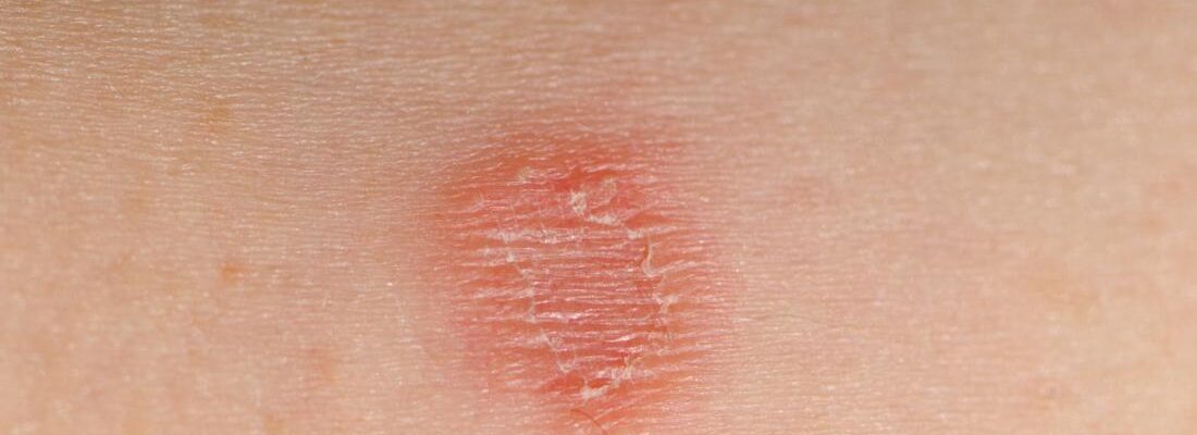 What Are the Symptoms of Ringworm