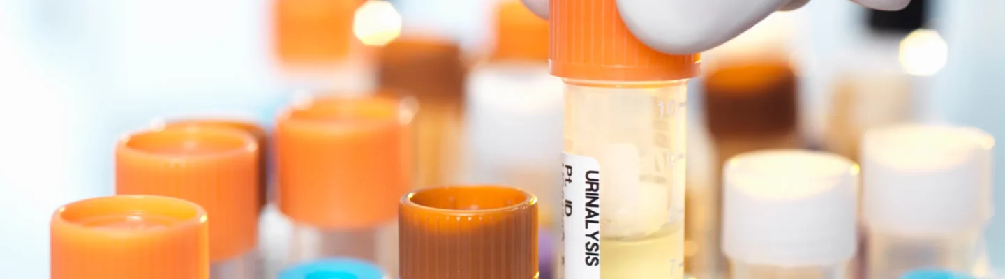 What is Urinalysis or Urine Examination?
