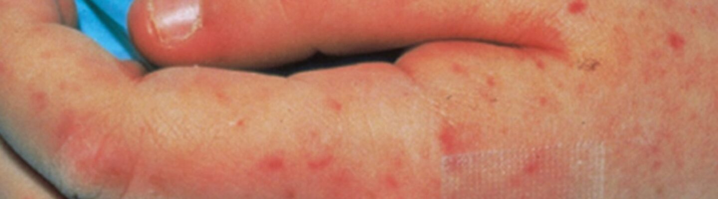 Meningococcemia
