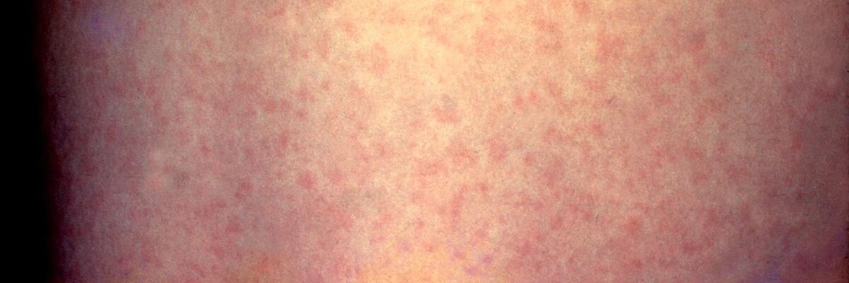 German Measles (Rubella)