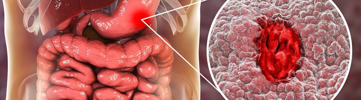 Peptic Ulcer