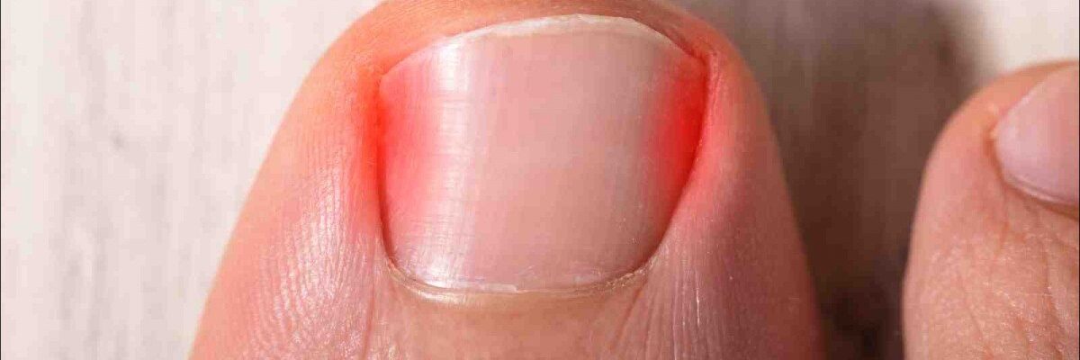 Ingrown Toenail Treatment Tips
