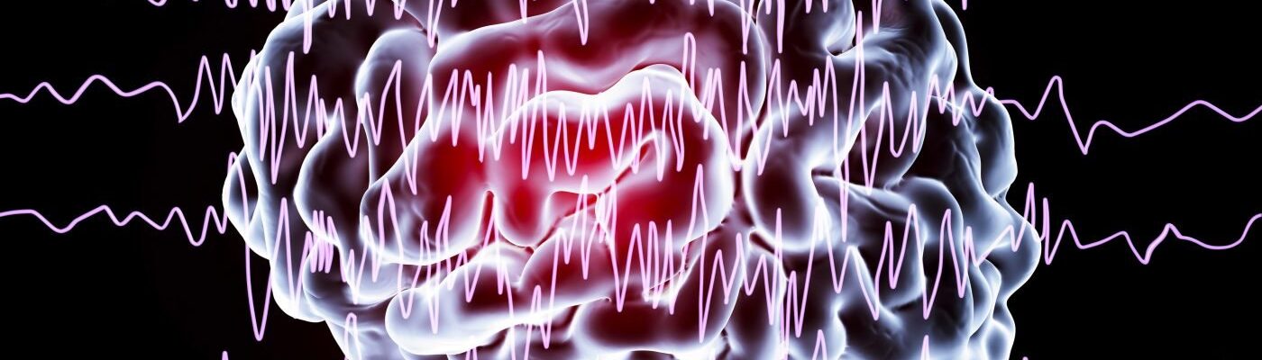 How Epilepsy is Diagnosed