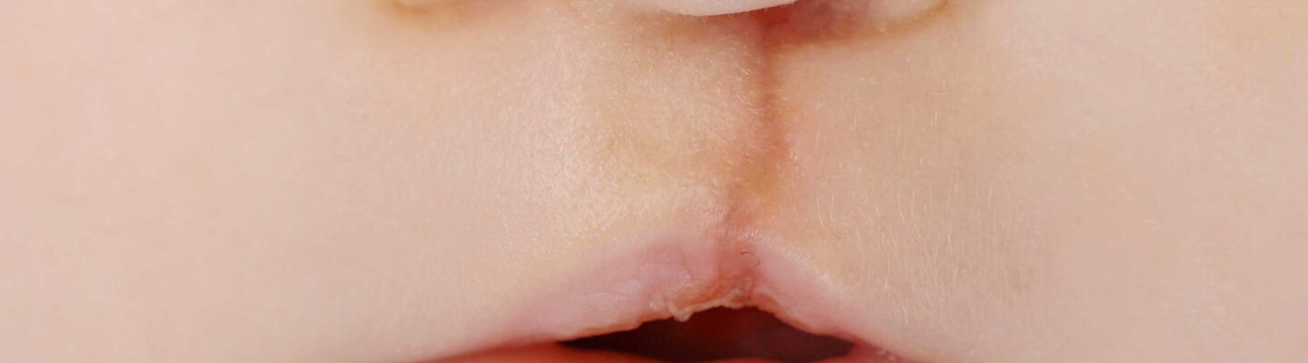 Cleft Lip and Palate