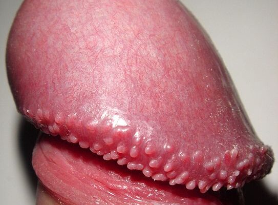 Small Bumps on the Edge of the Penis Head: What Are They?