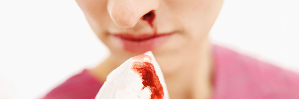 Nose Bleeding or Nosebleeds