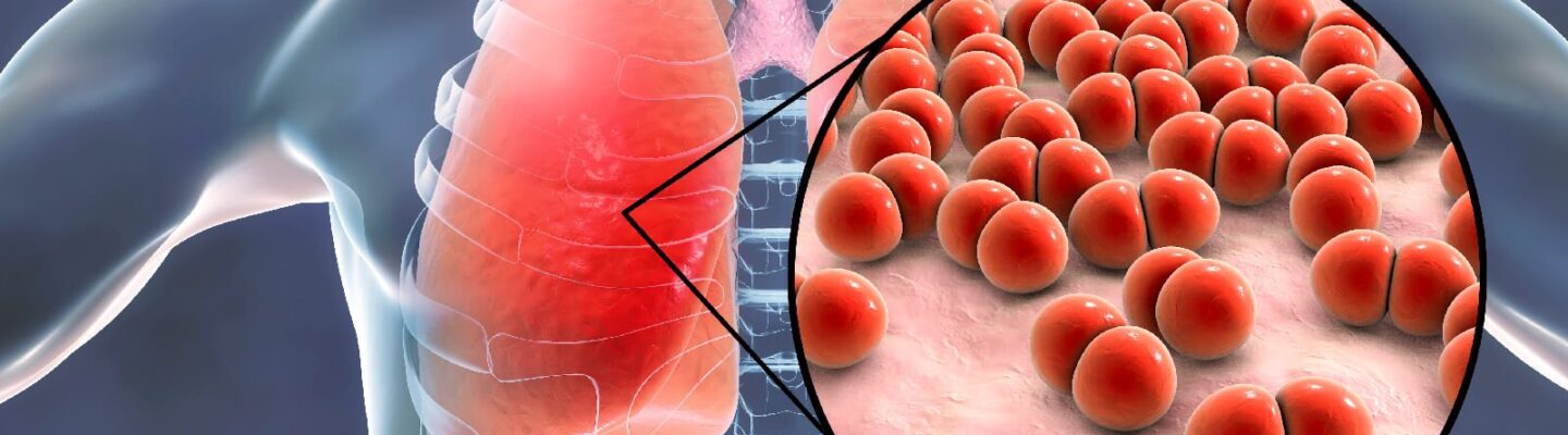 How to Prevent Pneumonia
