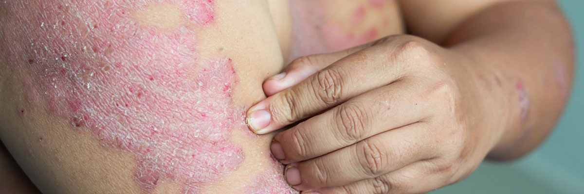 Psoriasis