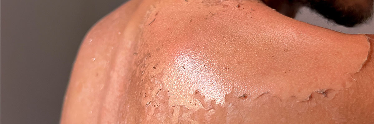 Sunburn