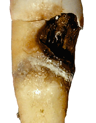 Understanding Dental Examinations for Tooth Decay